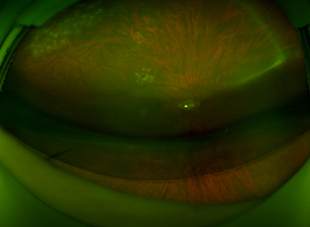 수술 후 2일 사진